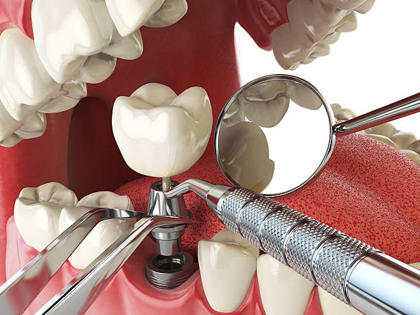 Best Emergency Root Canal Treatment in Treasure Island, FL